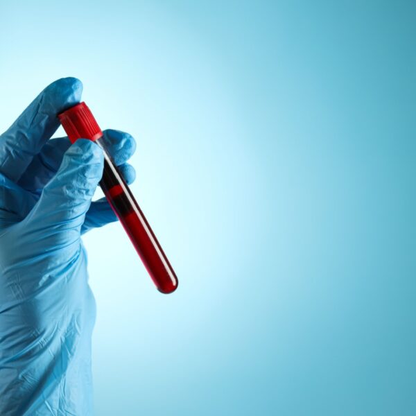 Proteina Plasmatica A Associada A Gravidez (papp-a)